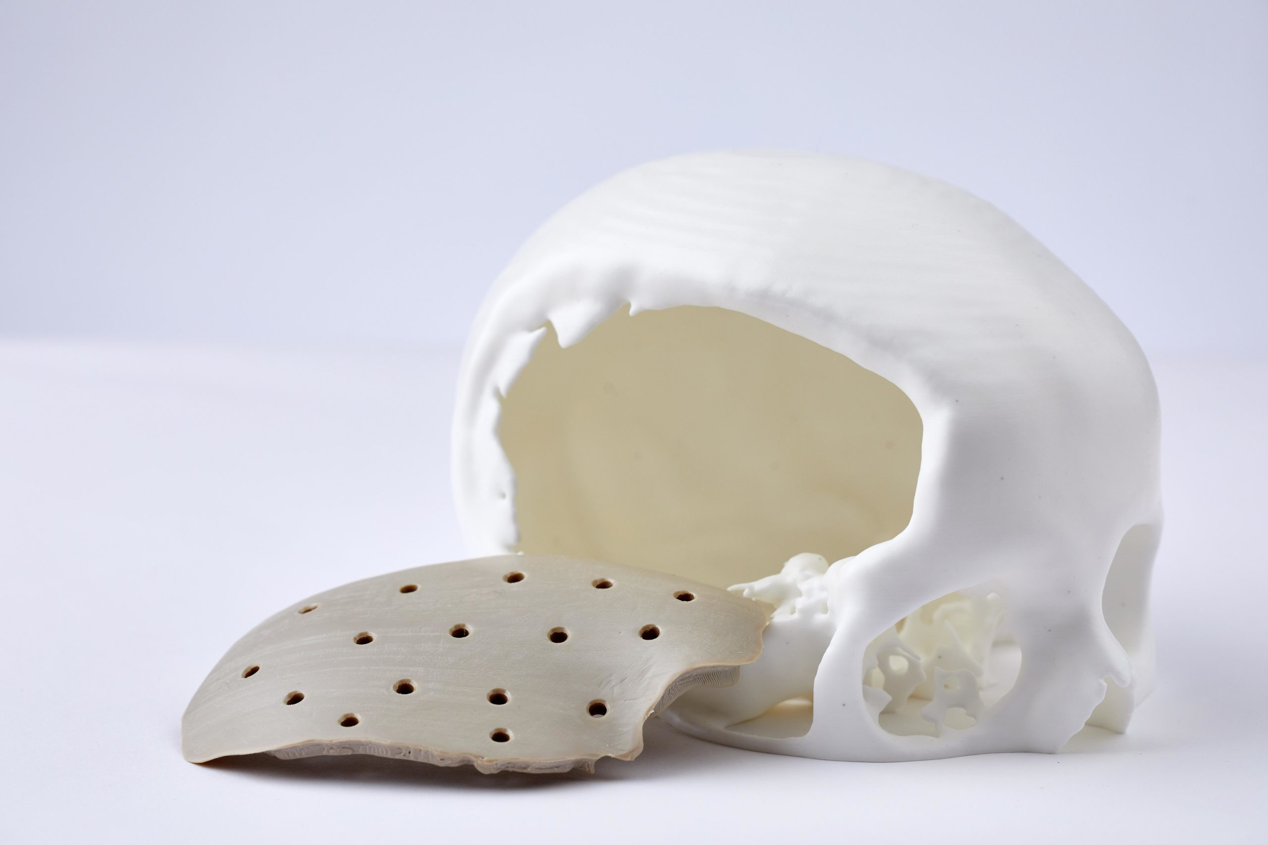 5 3d Printed Cranial Implant Scaled