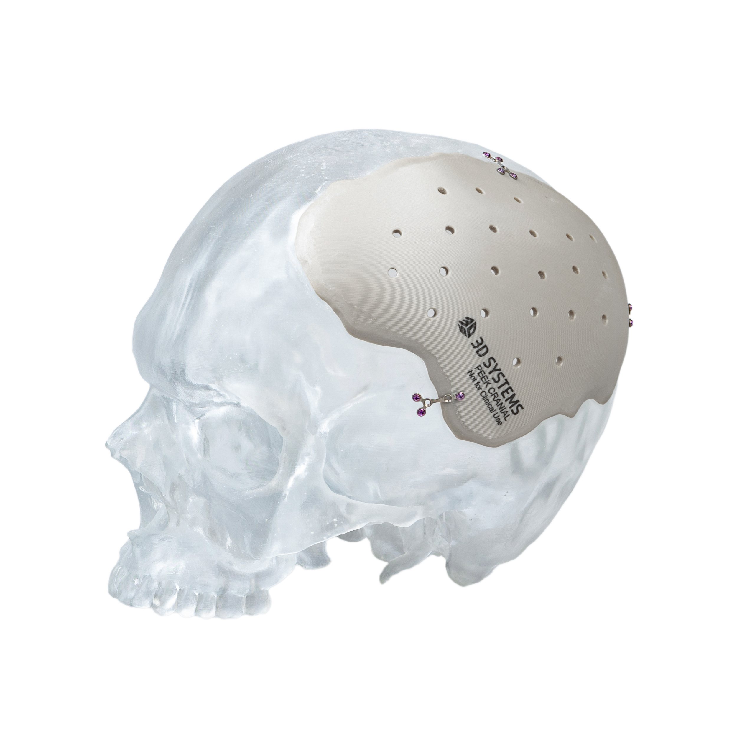Ext Peek Cranial Plate Skull Healthcare 2